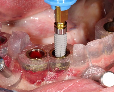 Implant Oral Surgery