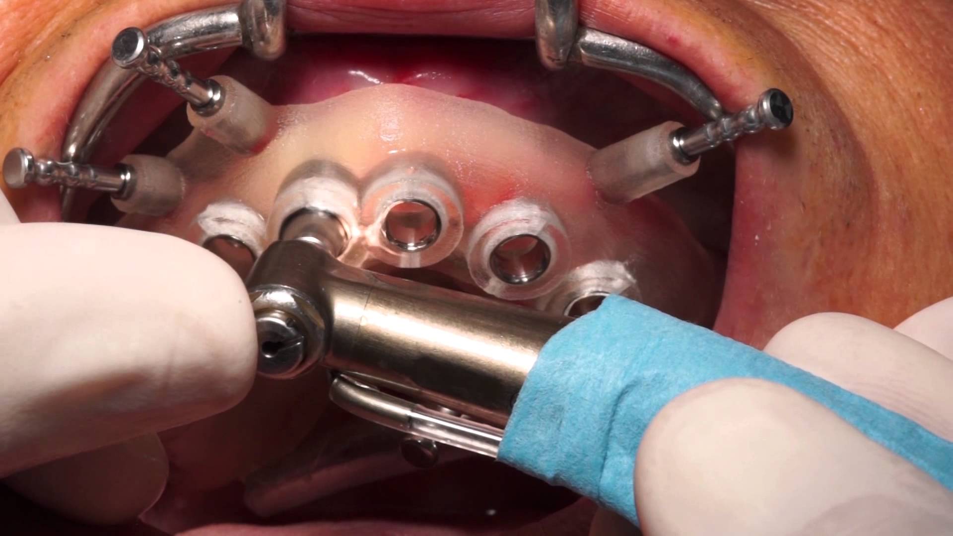 Implantes dentales Granada